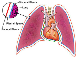 What is pleurisy? pleurisy in the lungs