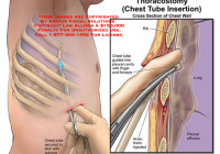 chest tube insertion