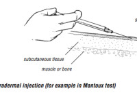 intradermal injection