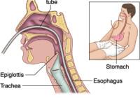 nasogastric tube insertion