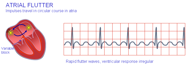 atrial flutter ecg and heart