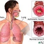 bronchial asthma diagram