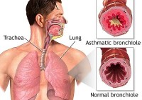 bronchial asthma diagram