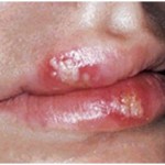 herpes symptoms on the mouth