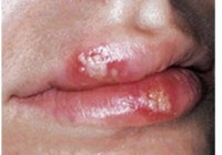 herpes symptoms on the mouth