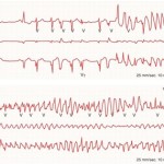 irregular heart rhythm