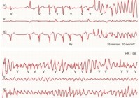 irregular heart rhythm