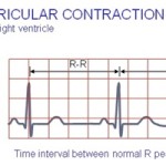 premature ventricular contractions pvc