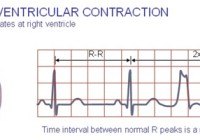 premature ventricular contractions pvc