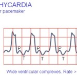 ventricular tachycardia wave