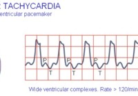 ventricular tachycardia wave