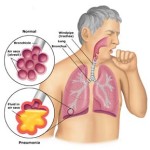 walking pneumonia symptoms