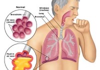 walking pneumonia symptoms