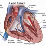 congestive heart failure diagram