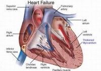 congestive heart failure diagram