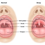 strep throat symptoms and pains