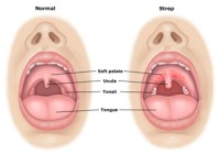 strep throat symptoms and pains