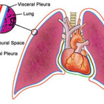 pleurisy in the lungs