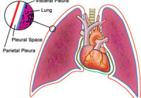 pleurisy in the lungs